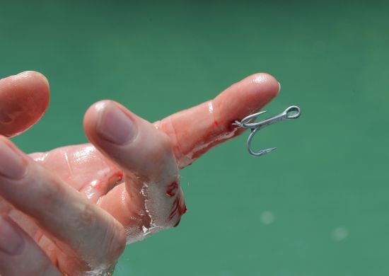 Ouch!! Fish hook injuries - Fishing World Australia