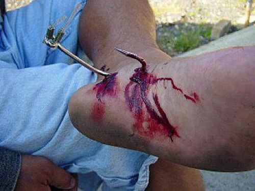 Ouch!! Fish hook injuries - Fishing World Australia