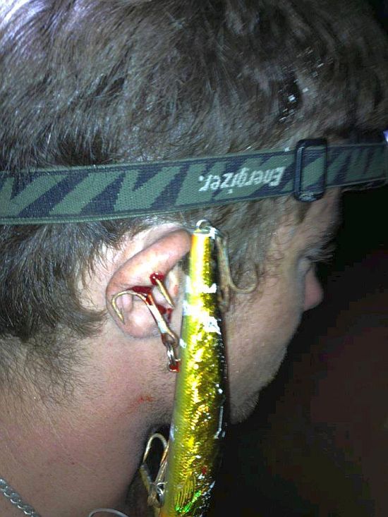 Ouch!! Fish hook injuries - Fishing World Australia