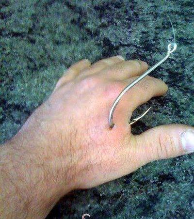 fishing hook accidents